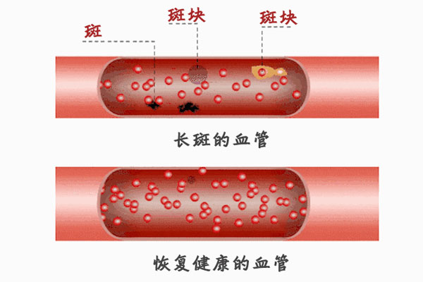 血管里的斑块 斑块能消融